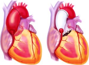 Aort Kapak Ameliyatı Nedir?