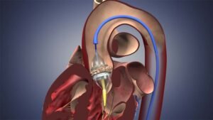 Mitral Kapak Ameliyatı Nedir?