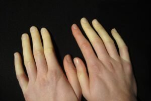 Raynaud Hastalığı Nedir?